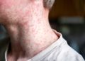 Measles outbreak expands in West Texas around county with low vaccination rate